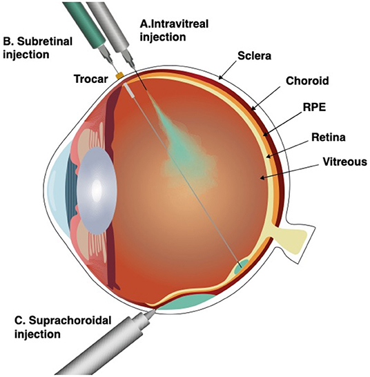 Safe And Effective Intravitreal Injections In Mira Road Shreeji Eye