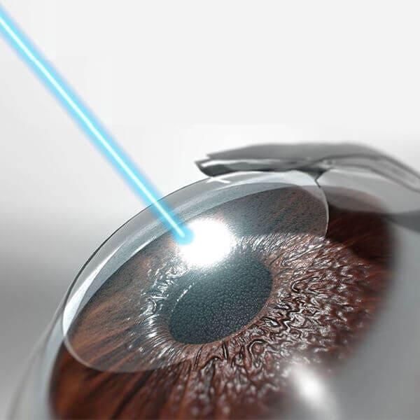 retina lasers