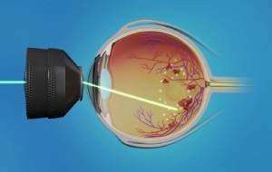 Retina Lasers And Surger