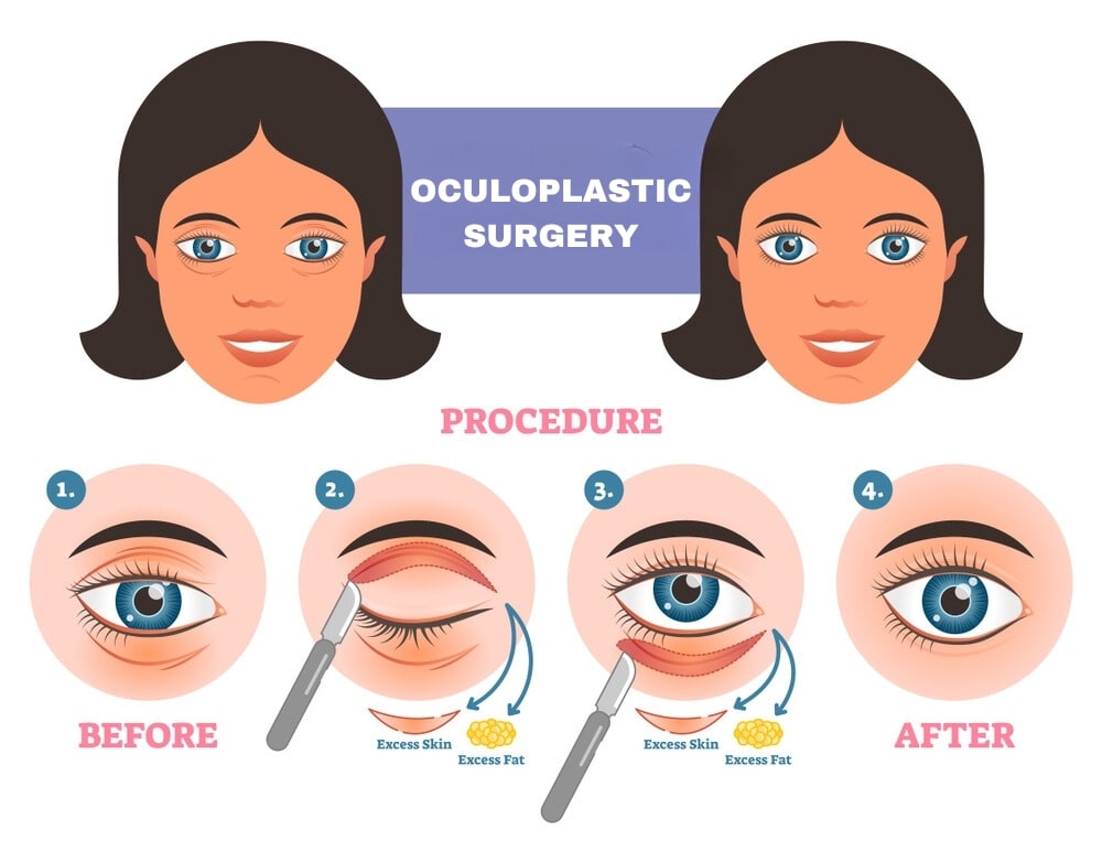 Oculoplasty Surgery
